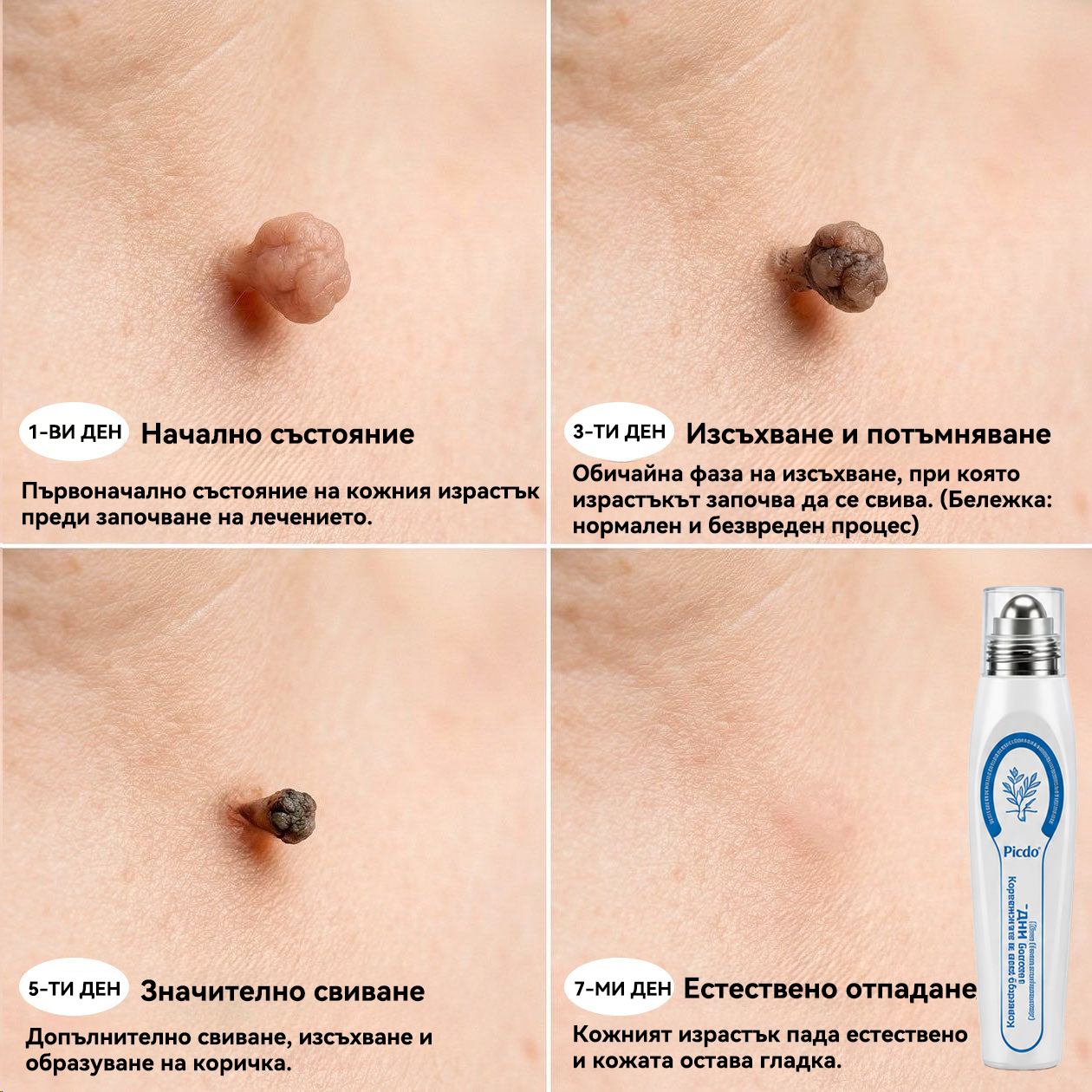 🌱 Официален магазин на водещата марка | 👩‍⚕️𝐏𝐢𝒄𝒅𝒐® 7-дневен серум за премахване на тъмни петна и кожни образувания (безболезнен дизайн с ролковидни топчета; не оставя белези) 🌳