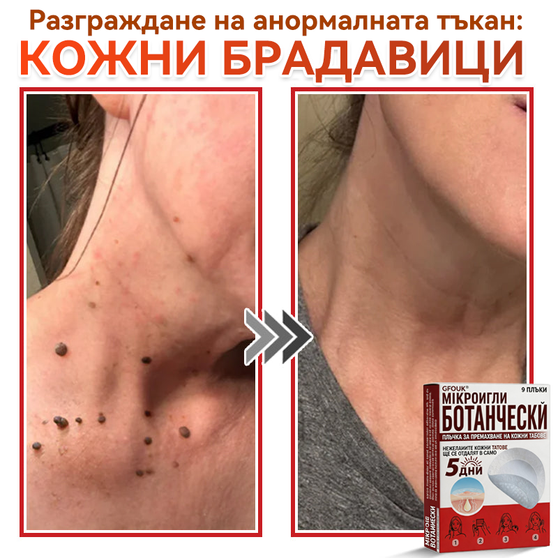 🗽✅ GFOUK® Ботаничен пластир с микроигли за премахване на кожни образувания 🇺🇸 Произведено в САЩ